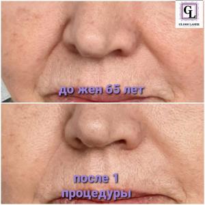 Фотография Gloss Laser 2